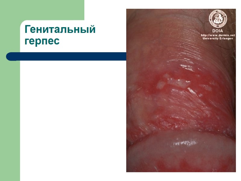 Генитальный герпес